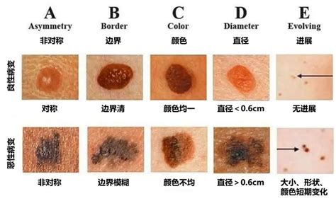 小拇指長痣|小拇指上长了一颗痣 小拇指上长了一颗痣代表什么